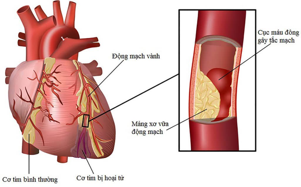 Hút thuốc lá làm tăng nguy cơ hình thành các mảng xơ vữa động mạch